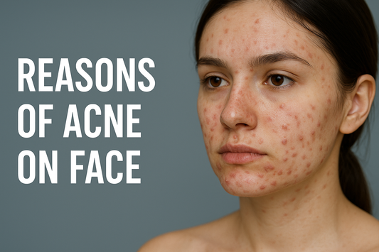 Reasons of Acne on Face: Understanding the Root Causes